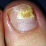 Toenail Fungus Rooted Stage