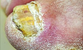 Toenail Fungus