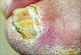Toenail Fungus