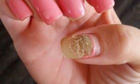 Acrylic Nail Fungus
