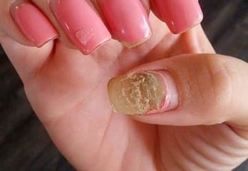 Acrylic Nail Fungus
