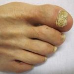 Nail fungus