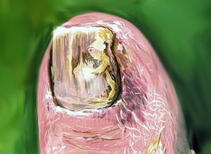 Toenail Fungus