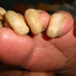Nail Fungus